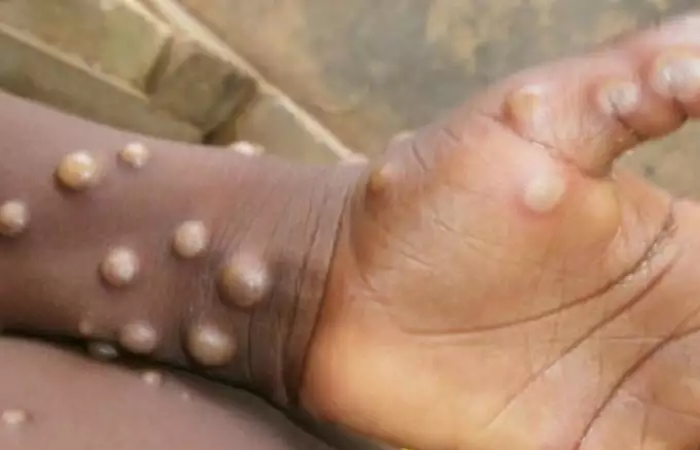 अमेरिका: टेक्सास में मंकीपॉक्स का पहला केस आया सामने, नाइजीरिया से लौटी महिला को हुआ संक्रमण