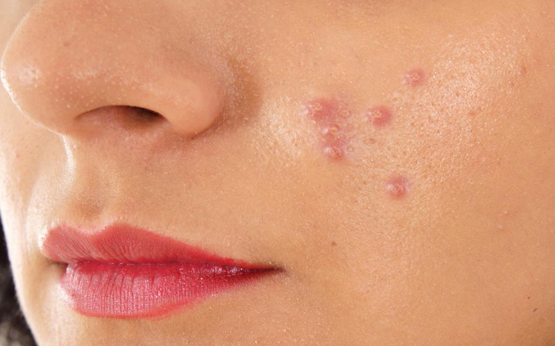 Pimple Problem :  ये चीजें दिलाएगी मुंहासों से छुटकारा